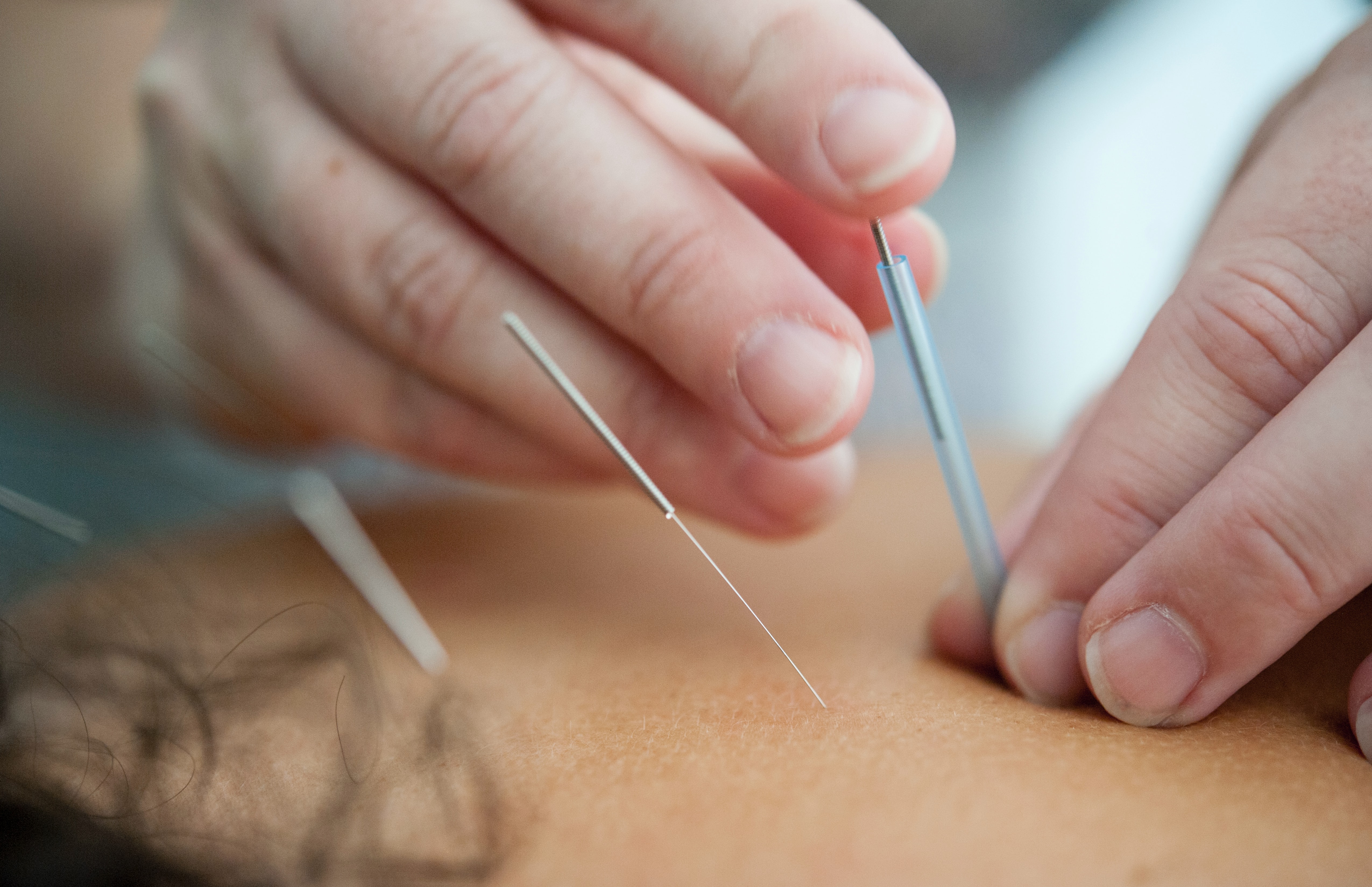 A person receiving acupuncture